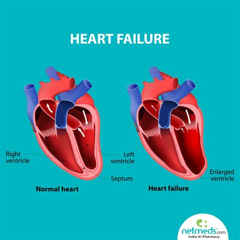 mild lv dysfunction|abnormal left ventricular relaxation symptoms.